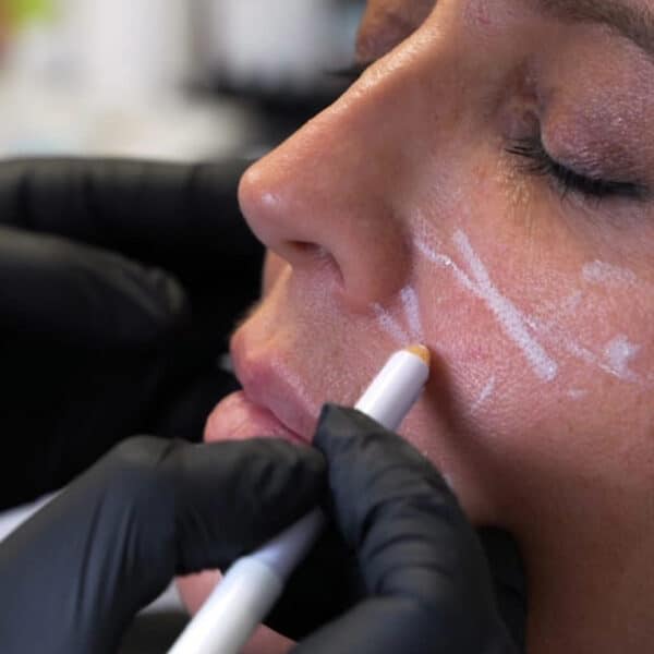 Close-up of a patient’s face during an aesthetic consultation at LightSculpt. A practitioner in black gloves marks the cheek area with a white pencil to plan a facial balancing treatment.