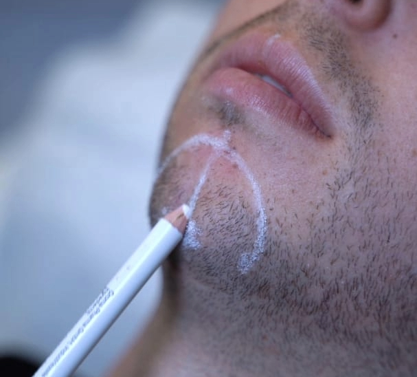 Men in aesthetics and subtle male aesthetic treatments at LightSculpt Green Point