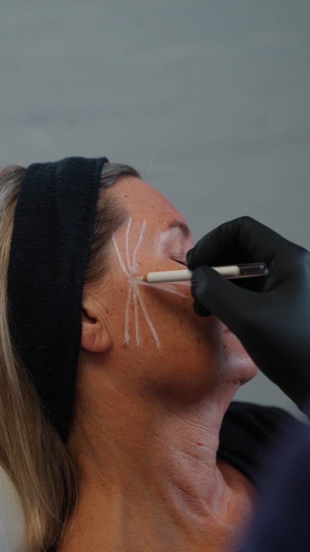 Doctor marking treatment areas before a personalised Sculptra treatment at LightSculpt.